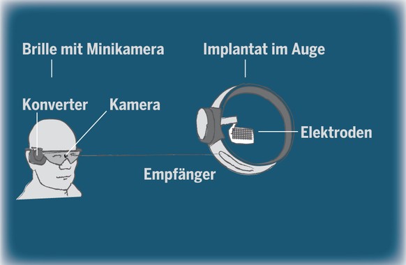 Eine Videokamera an der Brille filmt die Umgebung. Über einen Konverter wird das Bild in einzelne Pixel unterteilt und über Elektroden in der Netzhaut als feinste elektrische Impulse an den Sehnerv we ...