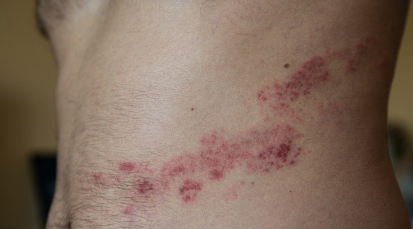 gürtelrose shingles herpes zoster