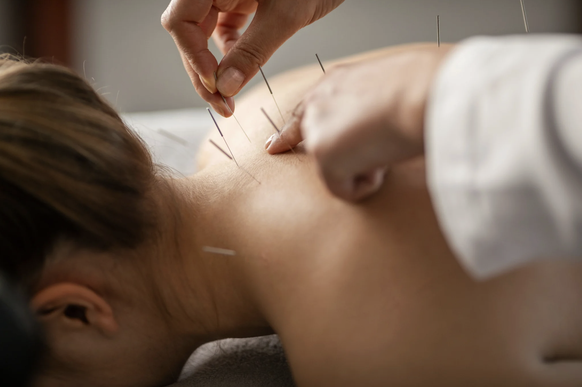 Akupunktur hilft bei manchen Leiden, die Symptome zu lindern.