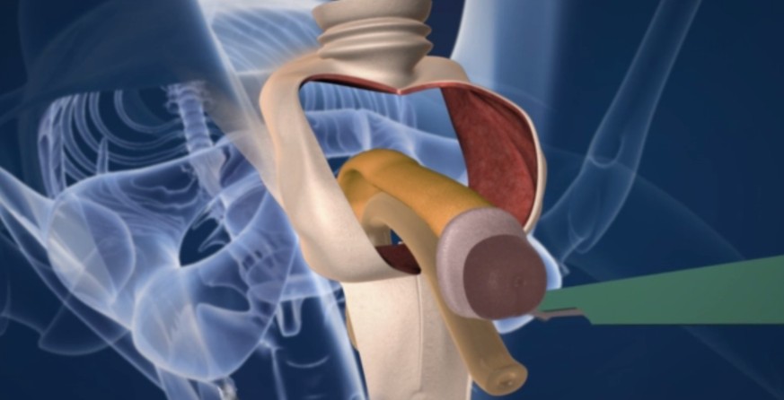 Diese Animation zeigt, wie aus einem Penis eine Vagina wird