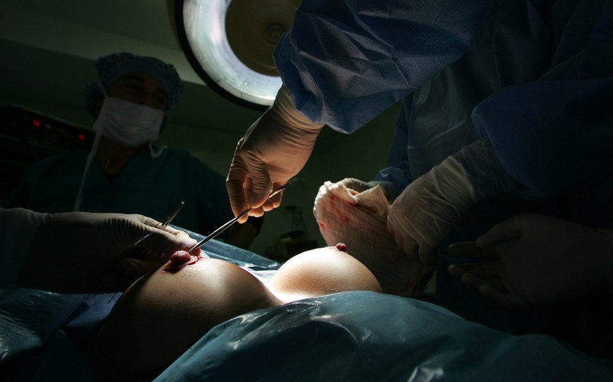 ** EDITORS NOTE NUDITY ** Dr. Carlos Vivas, right, performs a breast implant surgery at Grupo Zenho Medical Surgery Unit in Caracas, Monday, Jan. 22, 2007. (AP Photo/Leslie Mazoch)