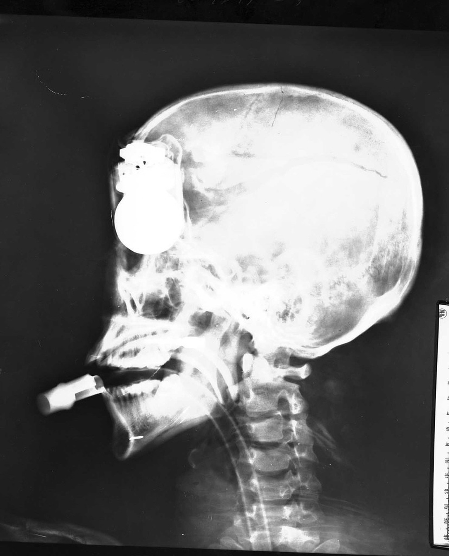 Über dieses Bild wird nur spekuliert: Der Sage nach ist es eine Röntgenaufnahme aus dem Vietnamkrieg. Dem Soldaten sei die Handgranate bei einer Explosion in den Schädel geschlagen worden. Über den Ve ...