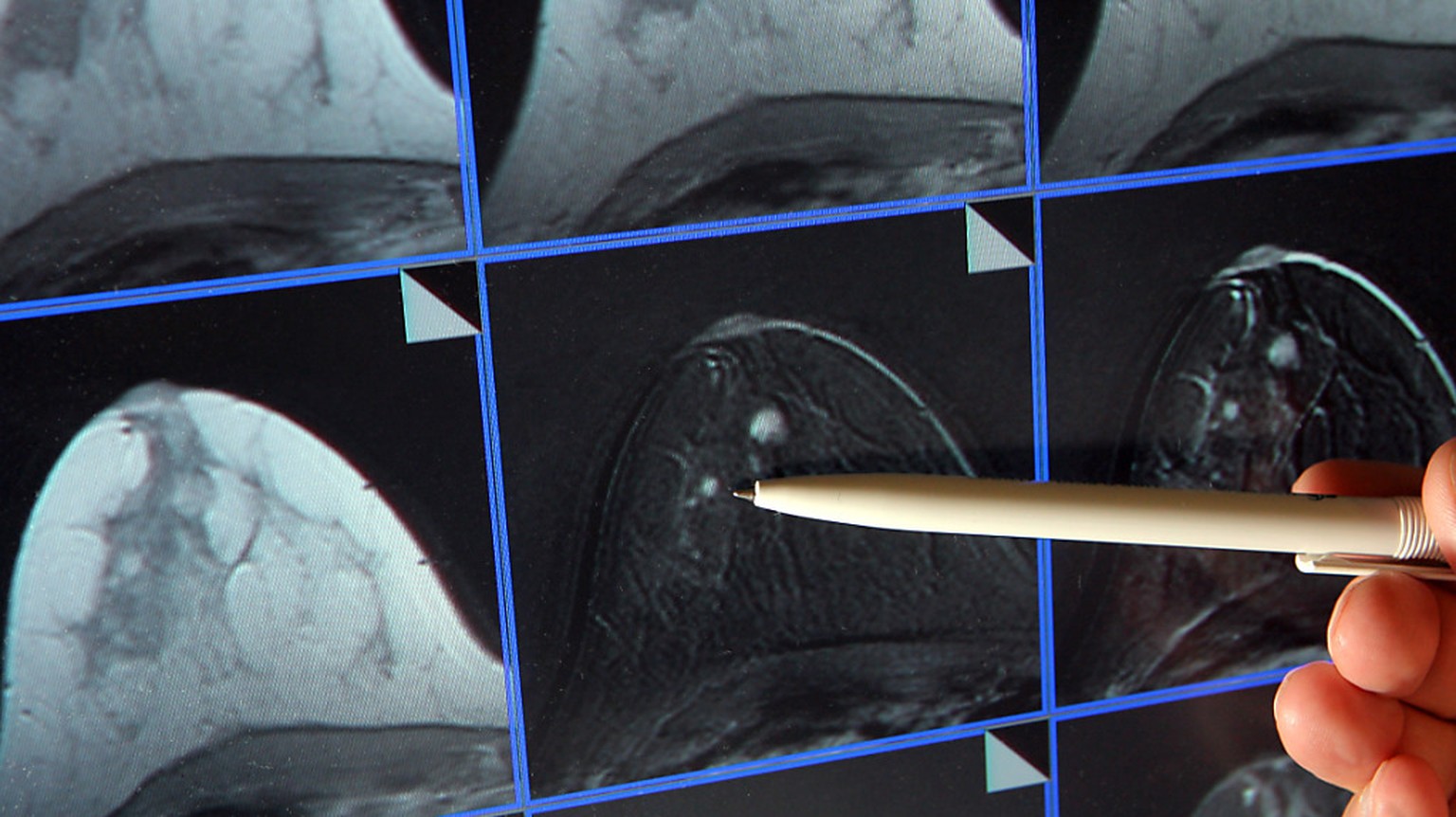 Bildschirmdarstellung einer Magnetresonanz-Mammographie. Dabei ist ein winziger Tumor in der Brust einer Patientin zu sehen. (Archivbild)