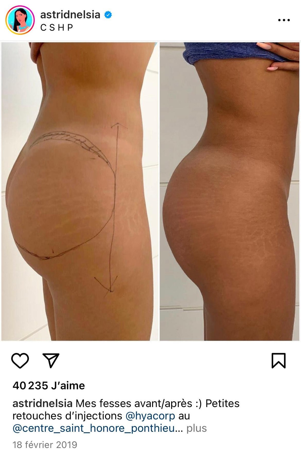 En 2018, l'influenceuse suisse Astrid Nelsia a publié son corps avant et après une intervention chirurgicale lui augmentant les fesses. La femme de 27 ans a indiqué en vouloir «toujours plus».