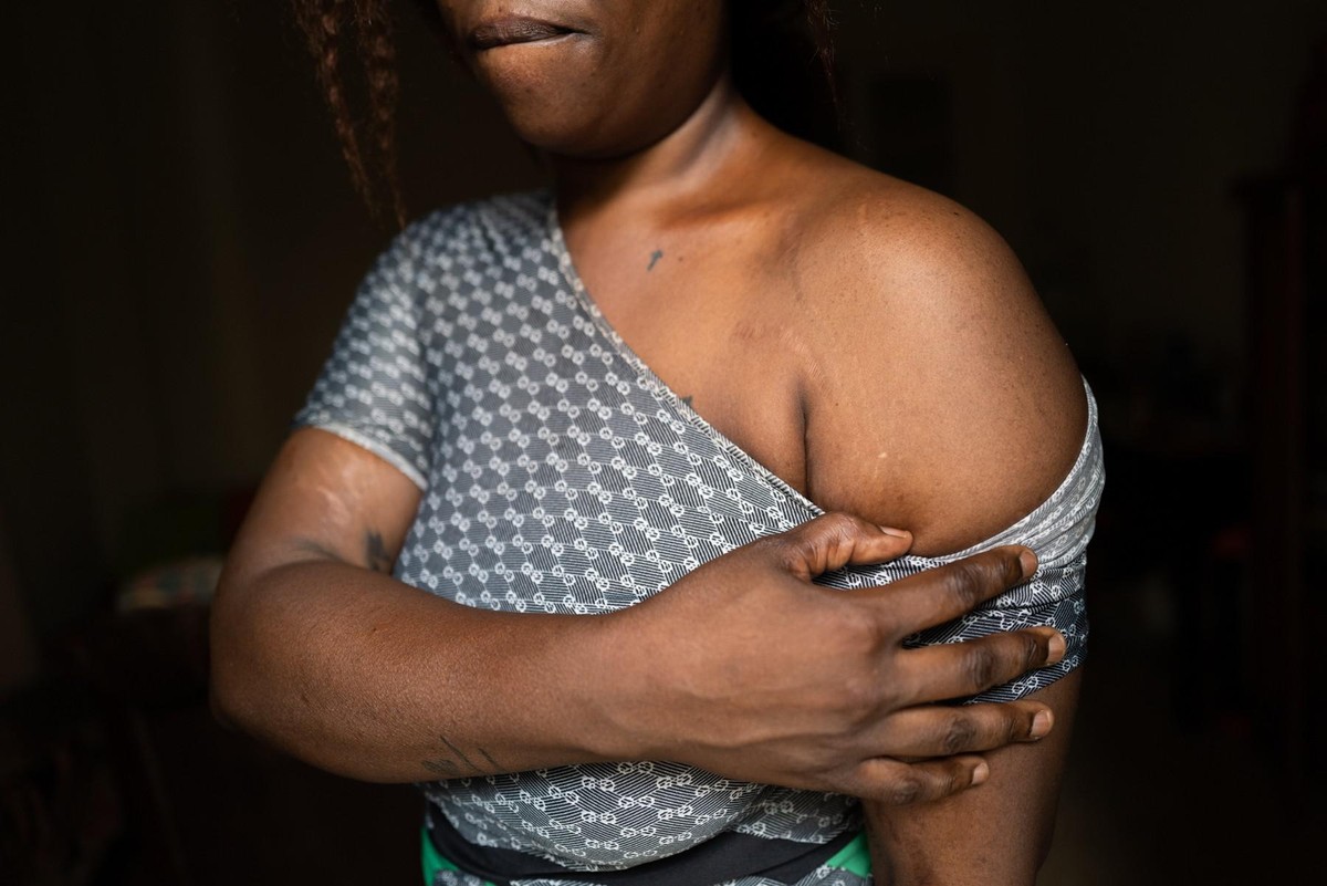 Melissa présente de larges cicatrices sur quasiment l'ensemble du corps, notamment les bras, la tête et les jambes.