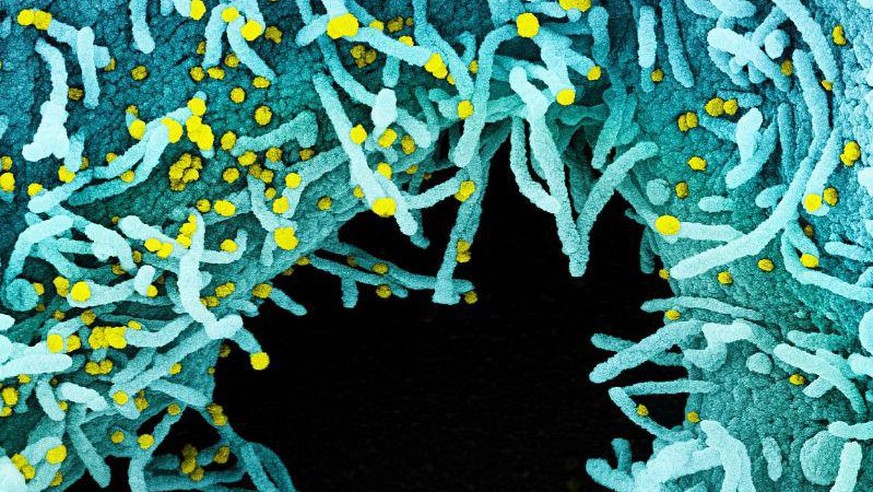 Colorised scanning electron micrograph of a cell heavily infected with SARS-CoV-2 virus particles (yellow). Credit: NIAID.