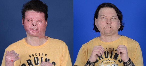 Joe DiMeo vor und nach der Transplantation.