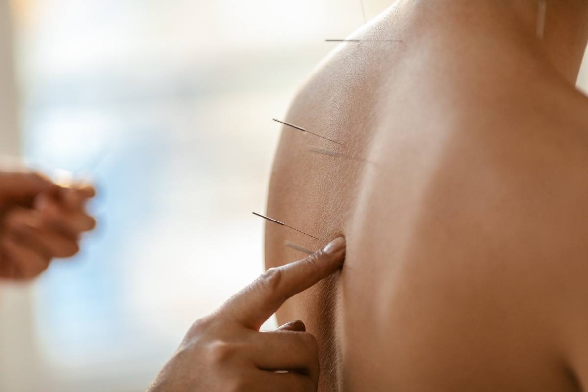 A young woman getting an acupuncture treatment on her back. She is standing in the therapist's office, the therapist is inserting acupuncture needles on her back.