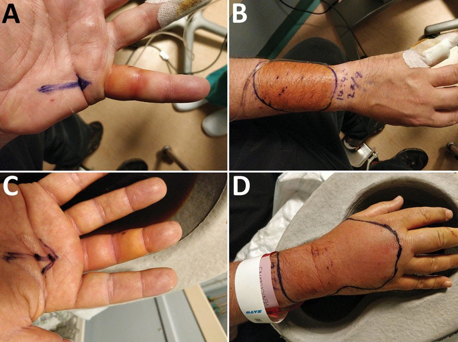 This is what a cat bite can look like a few hours later.  In this case (August 2023) even new bacteria were found.