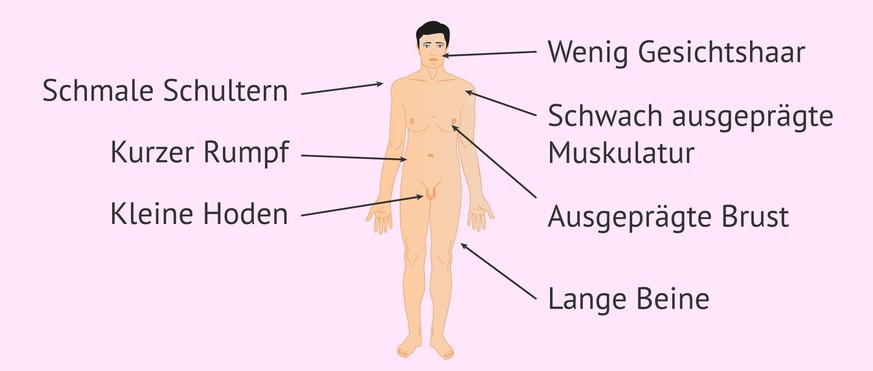 Körperliche Merkmale des Klinefelter-Syndroms
https://www.invitra.de/klinefelter-syndrom-und-schwangerschaft/merkmale-klinefelter-syndrom/