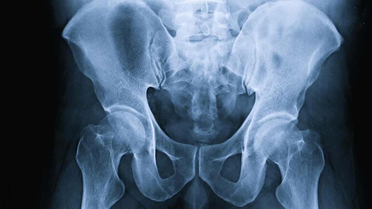 L'ostéoporose, qui touche surtout les femmes, mal diagnostiquée