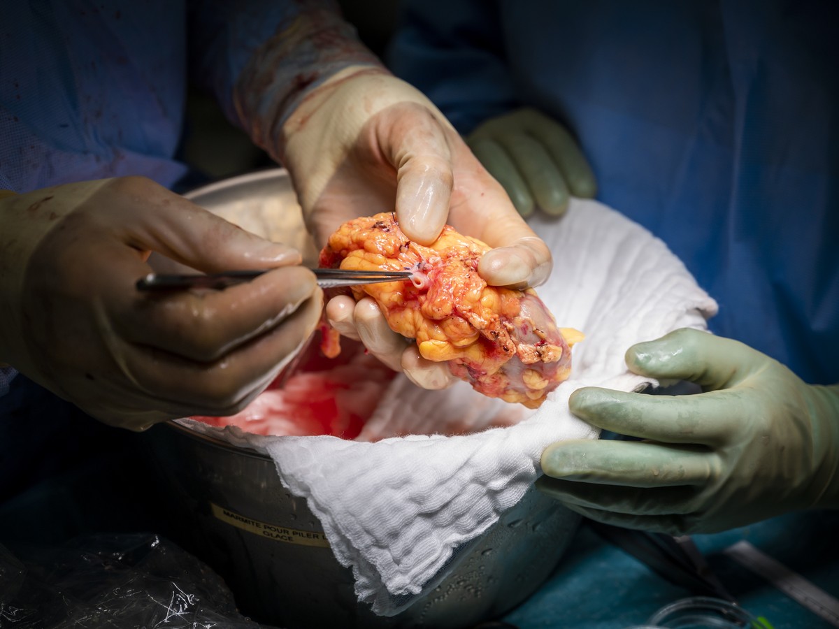 Des chirurgiens et des infirmiers procedent a une transplantation d'un rein dans un bloc operatoire du Centre Hospitalier Universitaire Vaudois, CHUV, le mardi 15 septembre 2020 a Lausanne. En su ...
