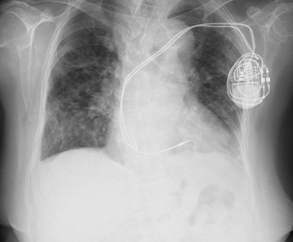 Pacemaker, X-ray Chest X-ray of a patient with a pacemaker. *** Pacemaker, X ray Chest X ray of a patient with a pacemaker PUBLICATIONxNOTxINxUKxFRAxUSAxCAN RAJAAISYA/SCIENCExPHOTOxLIBRARY F039/4347 R ...