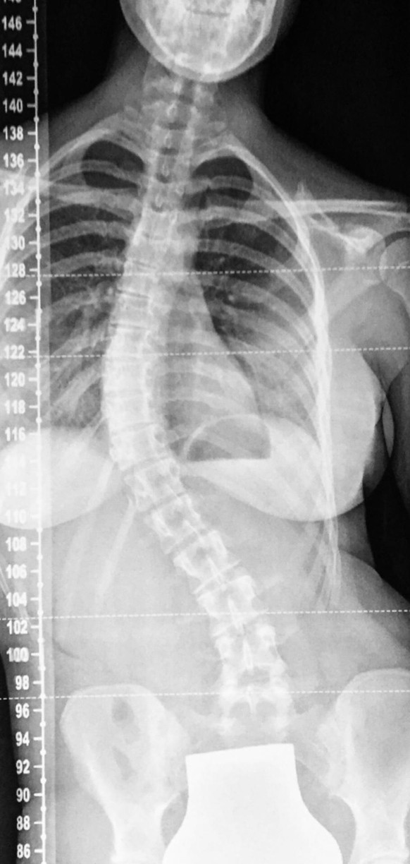 Naomis S-förmige Wirbelsäule zeigte kurz vor der Operation eine Verkrümmung von 56 Grad an.