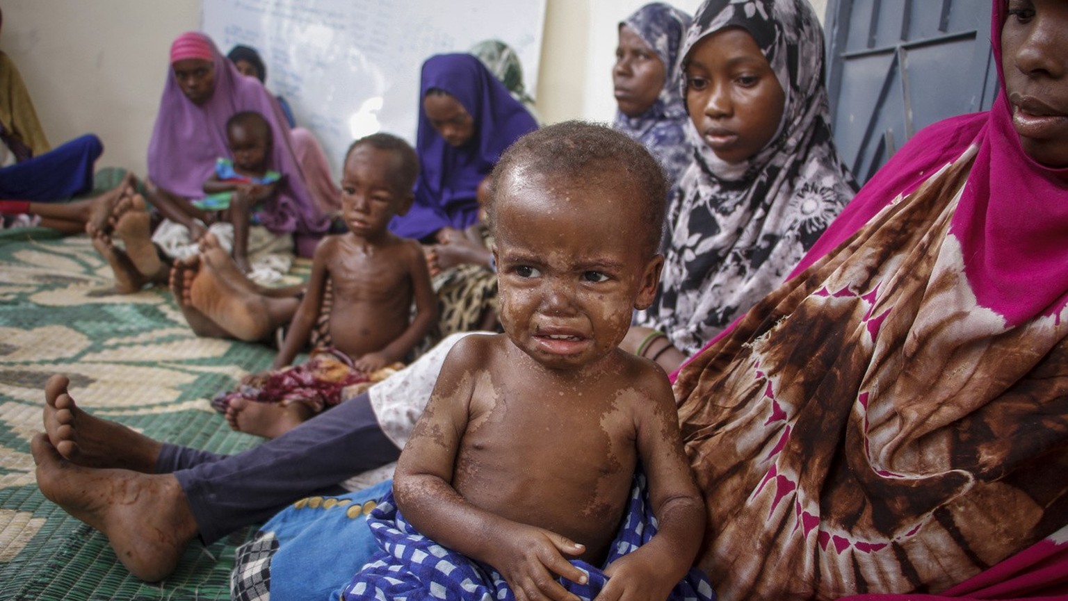 Somali children displaced by drought and showing symptoms of Kwashiorkor, a severe protein malnutrition causing swelling and skin lesions, sit with their mothers at a malnutrition stabilization center ...