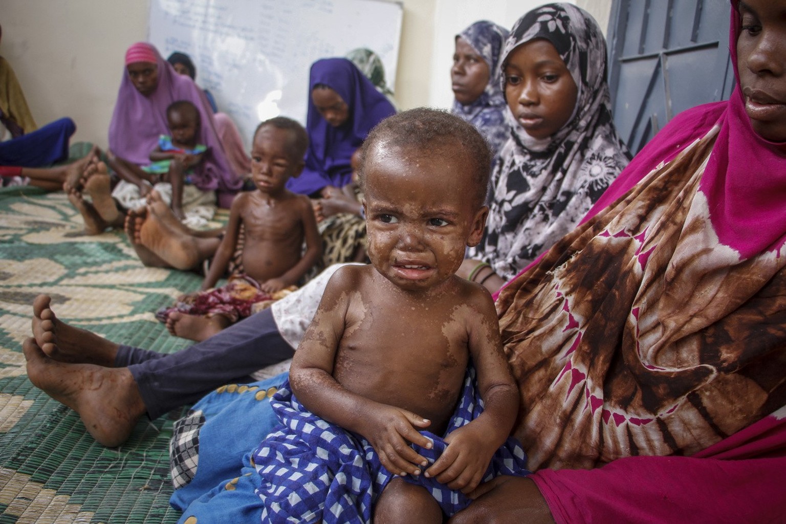 Somali children displaced by drought and showing symptoms of Kwashiorkor, a severe protein malnutrition causing swelling and skin lesions, sit with their mothers at a malnutrition stabilization center ...