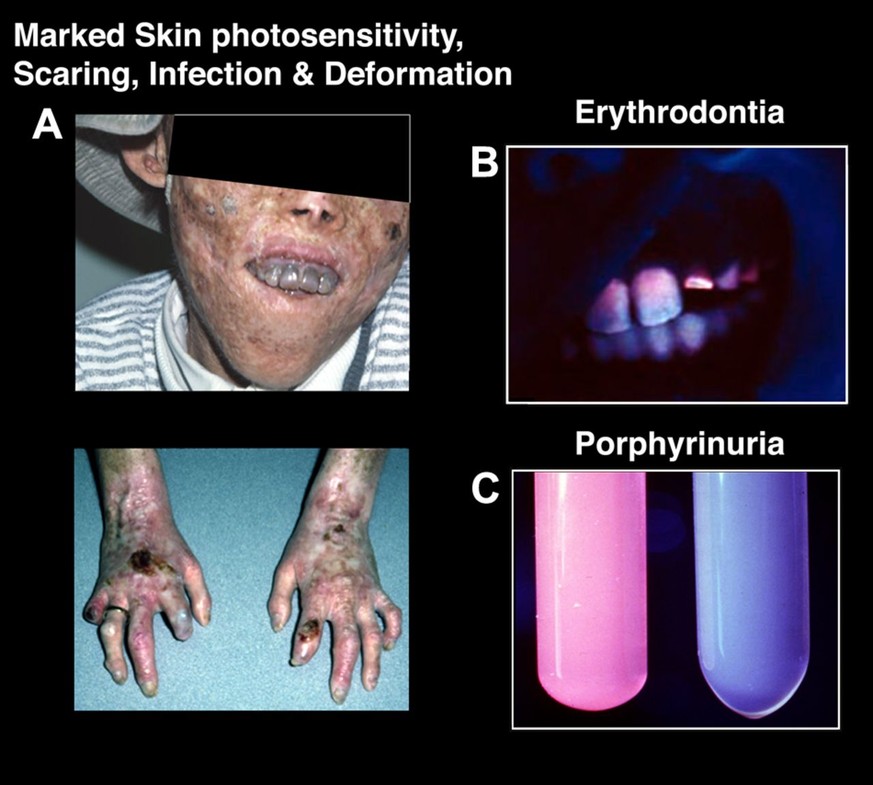 Krankheitsbild Porphyrie