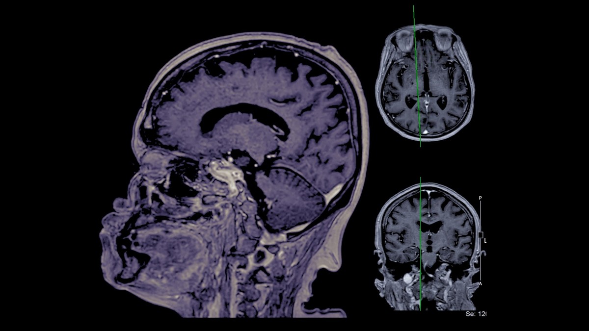 Hirnforschung Mit Lithium Gegen Alzheimer Darum Sollten Sie Jetzt Bescheid Wissen - 6w5dmcr