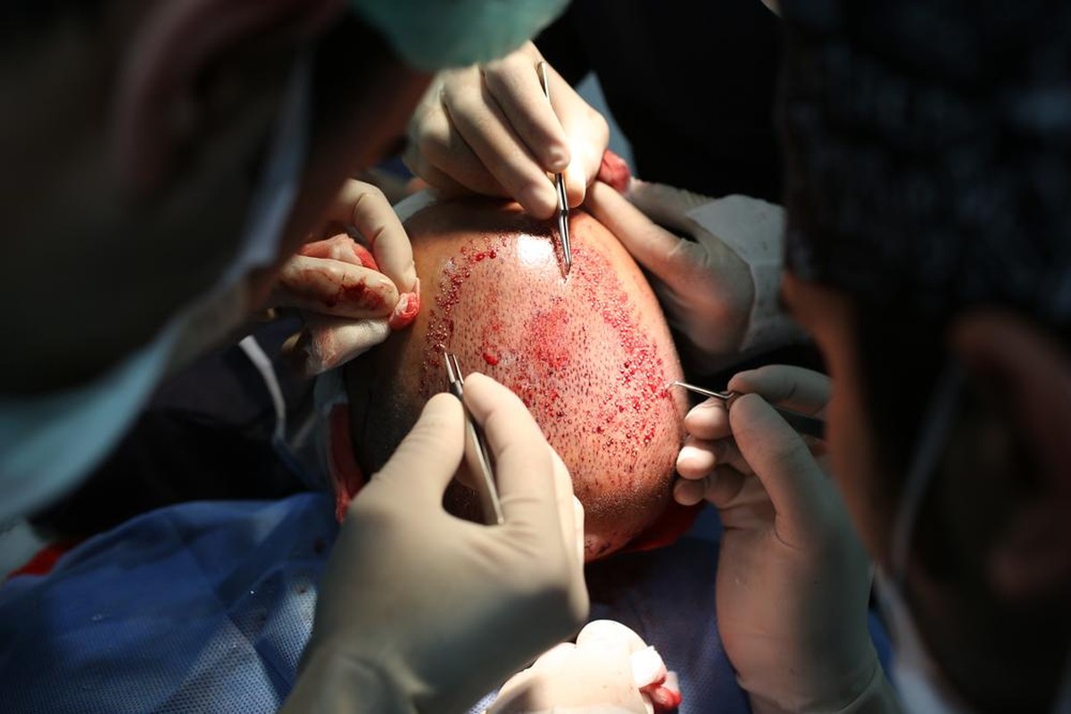Unangenehme Erfahrung: Die Haartransplantation dauerte bei Marco rund zehn Stunden.