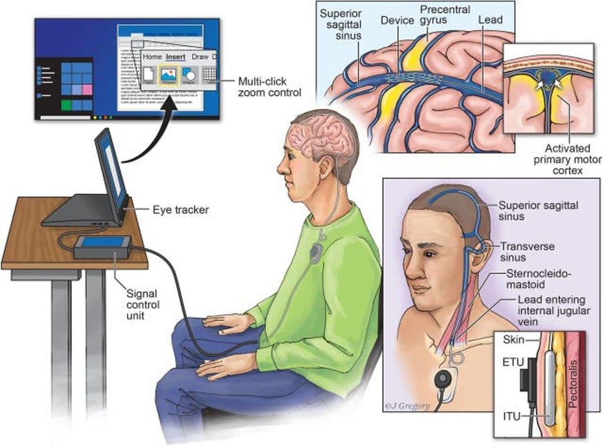 Das Stentrode-Gerät erlaubt eine direkte Kommunikation zwischen dem menschlichen Gehirn und dem Computer, ohne dass dafür etwas getippt oder gesprochen werden muss.