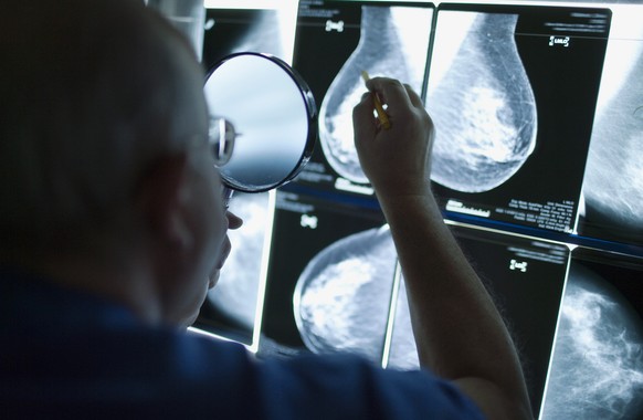 Detect breast cancer earlier: Aargau approves a funding program