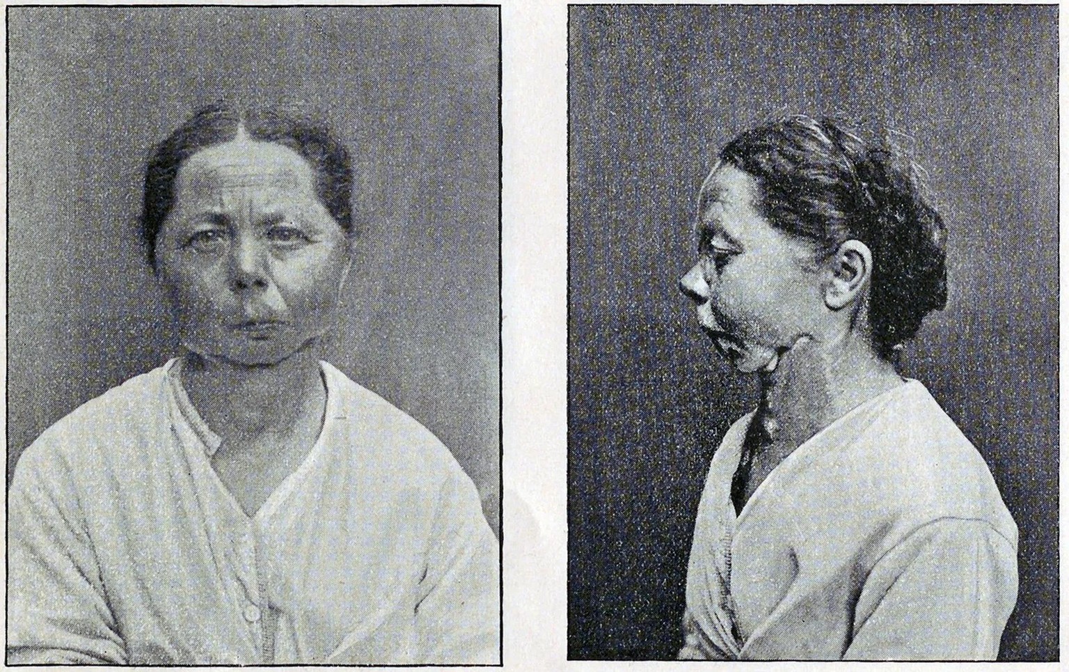 Der 1850 geborenen Margretha Trachsel aus Frutigen war wegen Nekrose der ganze Unterkiefer entfernt worden. Der Zeitpunkt der Operation ist nicht überliefert. Die Patientin kann nur zerkleinerte Speis ...