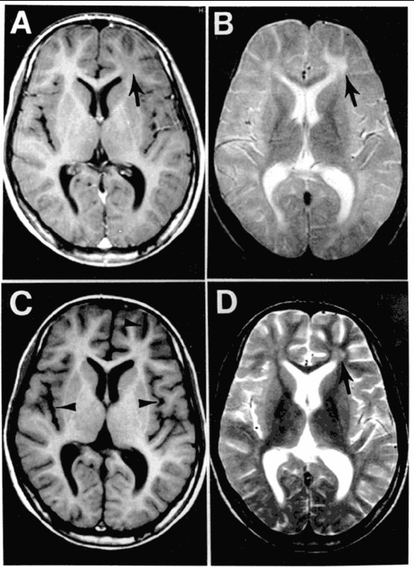 Die oberen MRT-Bilder A + B sind von der Erstuntersuchung eines SSPE-Patienten. Auf den Bildern C +D ist drei Monate später ein deutlicher Rückgang des Hirngewebes sichtbar (schwarze Pfeile bei C).