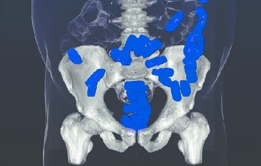 Rekonstruiertes CT mit Darstellung von verschluckten Drogenpaketen in Dickdarm und Rektum