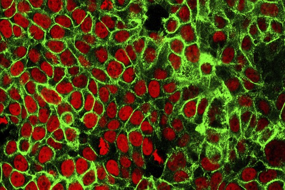 This microscope image made available by the National Cancer Institute Center for Cancer Research in 2015 shows human colon cancer cells with the nuclei stained red. On Friday, May 29, 2020, doctors ar ...