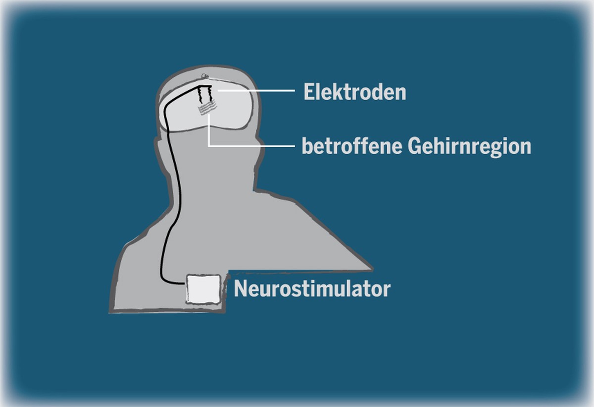 Implantierte Elektroden unter der Schädeldecke messen die Spannung auf der Hirnoberfläche von Epileptikern. Die Signale werden von den Elektroden über ein Kabel an einen Neurostimulator unterhalb des  ...