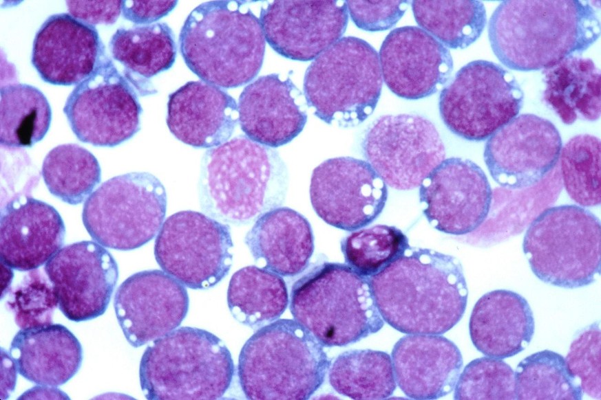 Epstein-Barr Virus (EBV): Stained with Hematoxylin and eosin (HE), is of the Epstein-Barr virus (EBV). 
https://commons.wikimedia.org/wiki/Category:Epstein-Barr_virus#/media/File:Epstein-barr_virus_(e ...