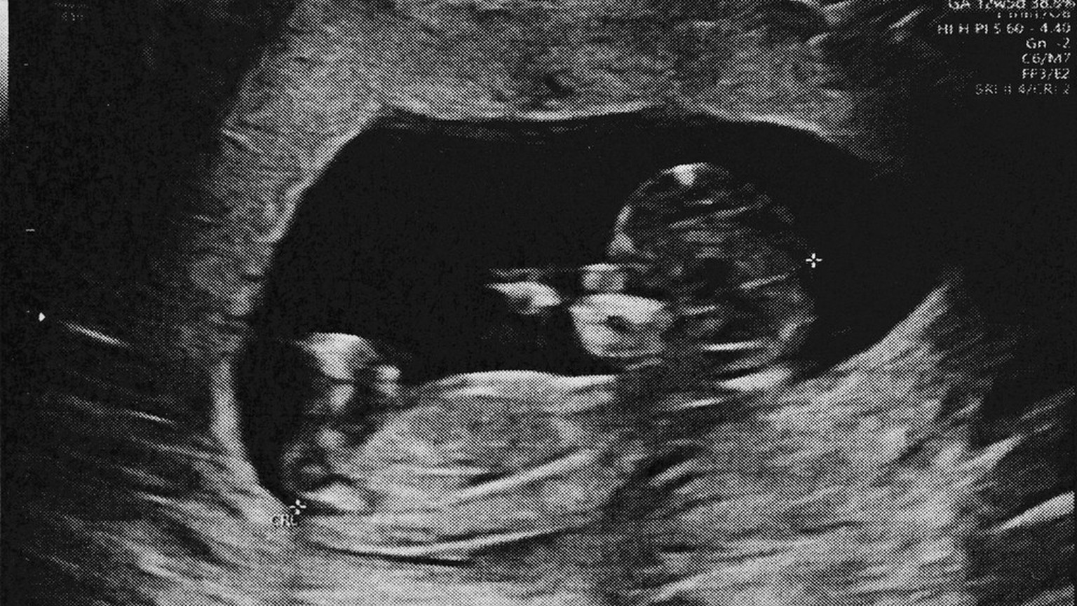 Ultraschall Fötus foetus