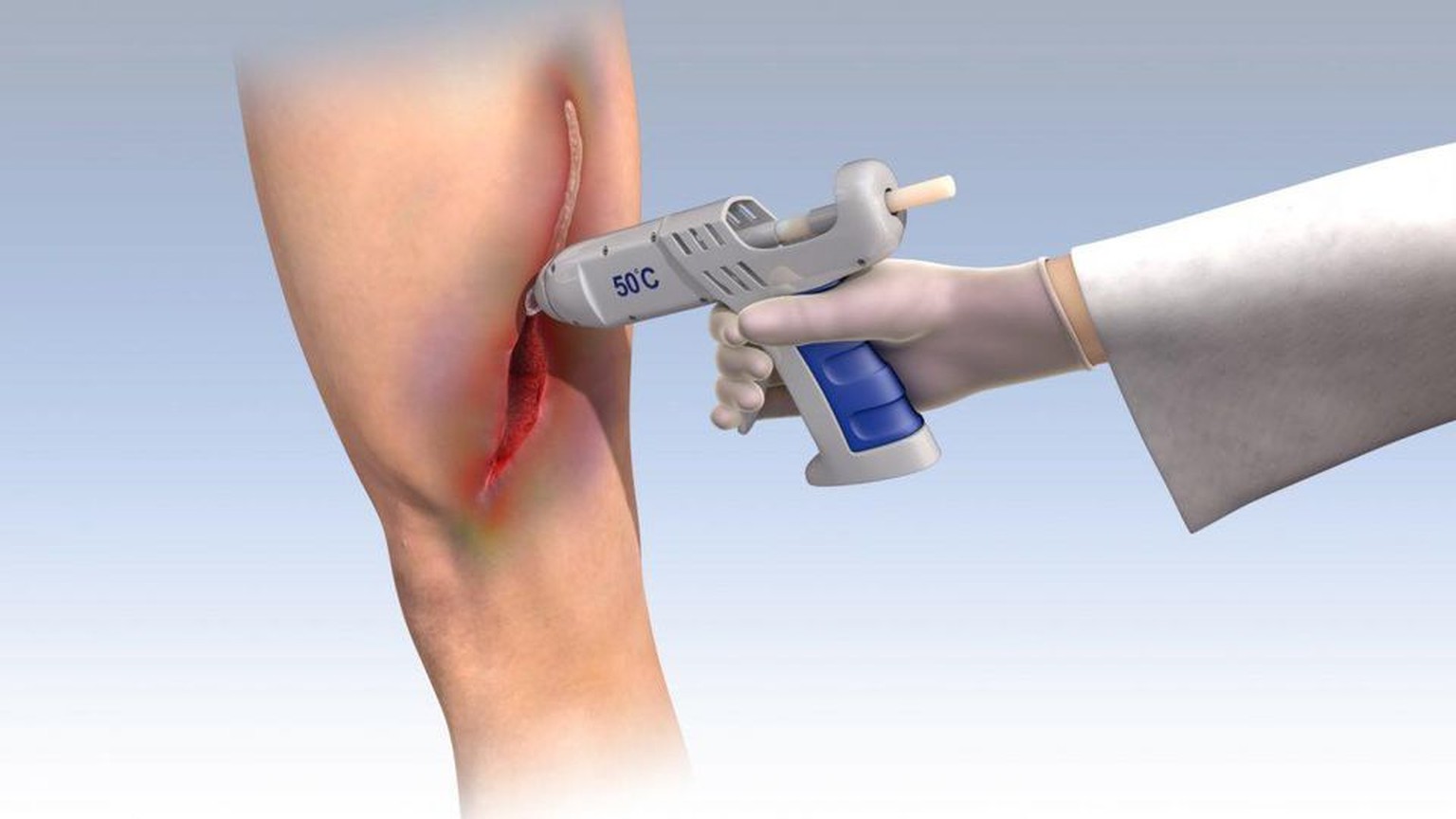 Klebestoff zur Wundversorgung, Wundheilung
https://www.technion.ac.il/en/2019/06/hot-glue-gun-for-advanced-healing/