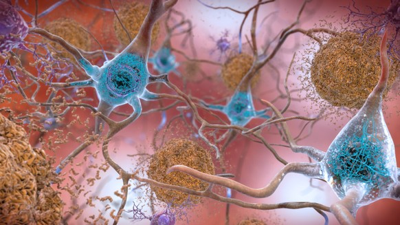 This illustration made available by the National Institute on Aging/National Institutes of Health depicts cells in an Alzheimer