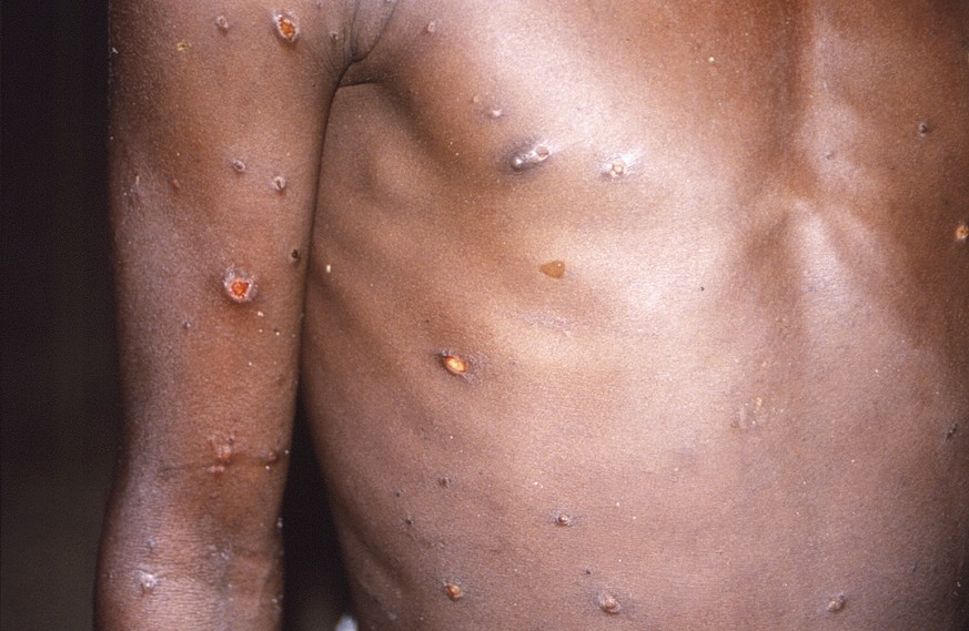 This 1997 image provided by CDC, shows the right arm and torso of a patient, whose skin displayed a number of lesions due to what had been an active case of monkeypox. As more cases of monkeypox are d ...