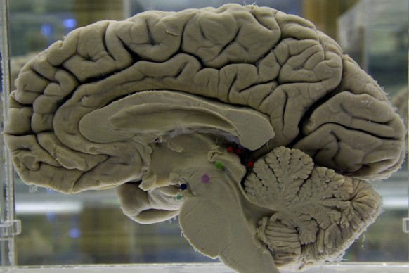 FILE - A section of a preserved human brain is displayed at the Museum of Neuroanatomy at the University at Buffalo, in Buffalo, N.Y., on Tuesday, Oct. 7, 2003. (AP Photo/David Duprey, File)
Brain-Com ...