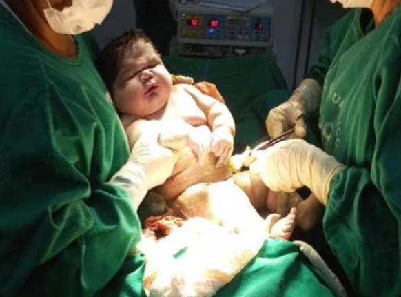 Das Baby Angerson aus Brasilien wog bei der Geburt 7,328 Kilo.