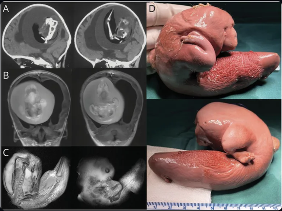 One child was hospitalized with developmental disabilities and a larger head.  Then the medics discovered a rare medical phenomenon.