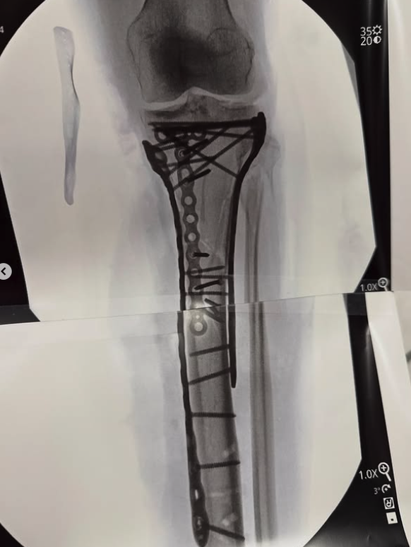 Das Bein von Vonn nach der Operation