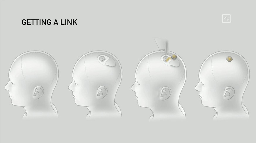 Ein Chip im Kopf soll Nervenschäden überbrücken und Gedanken zum Smartphone übertragen.