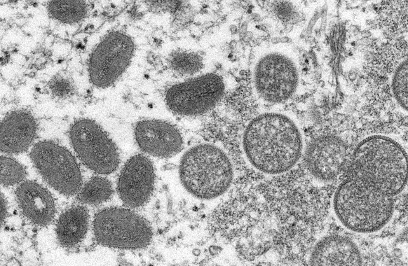 FILE - This 2003 electron microscope image made available by the Centers for Disease Control and Prevention shows mature, oval-shaped monkeypox virions, left, and spherical immature virions, right, ob ...