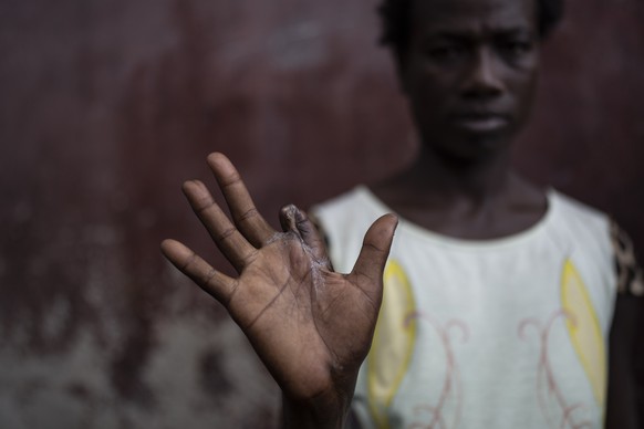 Lenlen Desir Fondala shows her hand that is missing a finger shot off by a stray bullet during a gang attack while she was living in Cite Soleil, as she stands in Jean-Kere Almicar?s front yard where  ...