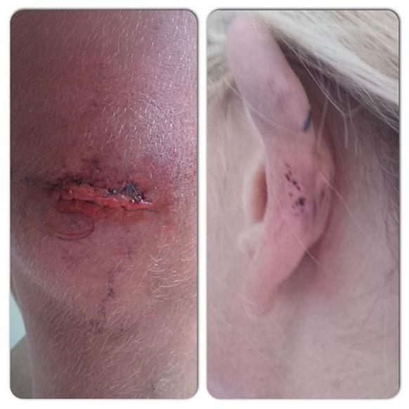 «Ich habe mir beim Baden in der Brandung mein Ohr aufgeschlagen –&nbsp;hätte die rote Flagge wohl ernster nehmen sollen!», so&nbsp;Elvers auf Facebook.&nbsp;