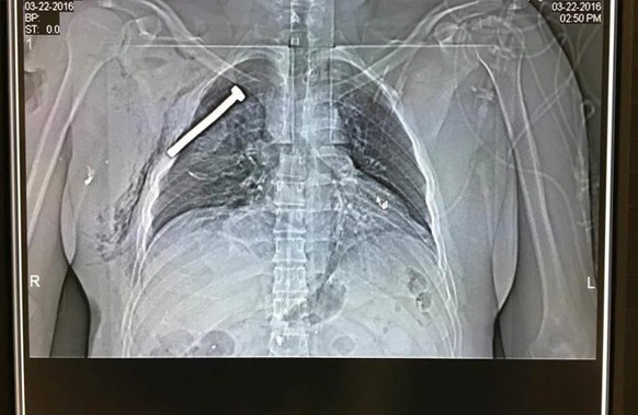 epa05225908 The x-ray image of a person injured during the Brussels terror attacks shows a big nail or screw in the chest of the patient treated at the Military Hospital in Neder-over-Heembeek in northern Brussels, 22 March 2016. Dozens of people have died and hundreds been injured in a series of explosions at Brussels Zaventem Airport and the metro station Brussels-Molenbeek 22 March 2016.  EPA/STRINGER
