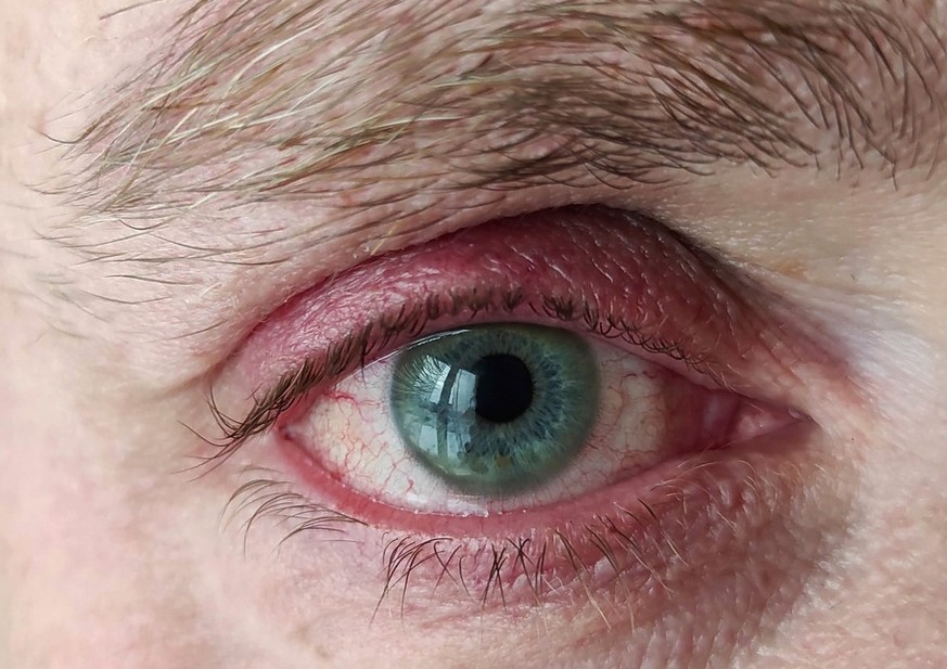 Entzündung der Augenlider (<em><a target="_blank" rel="follow" href="https://de.wikipedia.org/wiki/Blepharitis">Blepharitis</a></em>). 