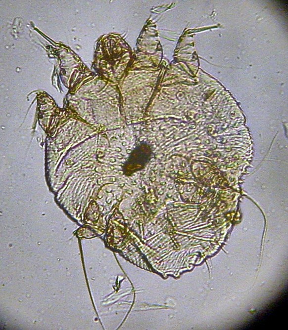 Scabies is back in Switzerland – 7 points on the contagious disease