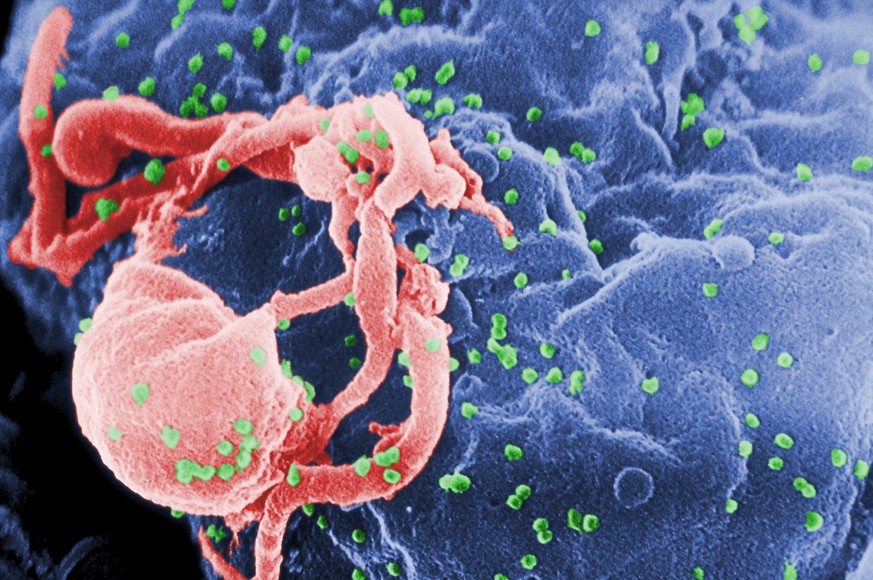 This undated photo provided by the Centers for Disease Control and Prevention shows a scanning electron micrograph of multiple round bumps of the HIV-1 virus on a cell surface. In a report released on ...