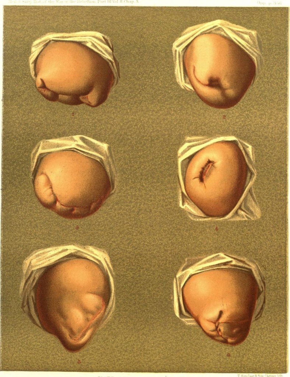 Color print depicting six images of the stumps remaining after human thighs were amputated, numbered 1-6 to indicate the amputation style, by anterior flap, posterior flap, anterior-posterior flaps, c ...