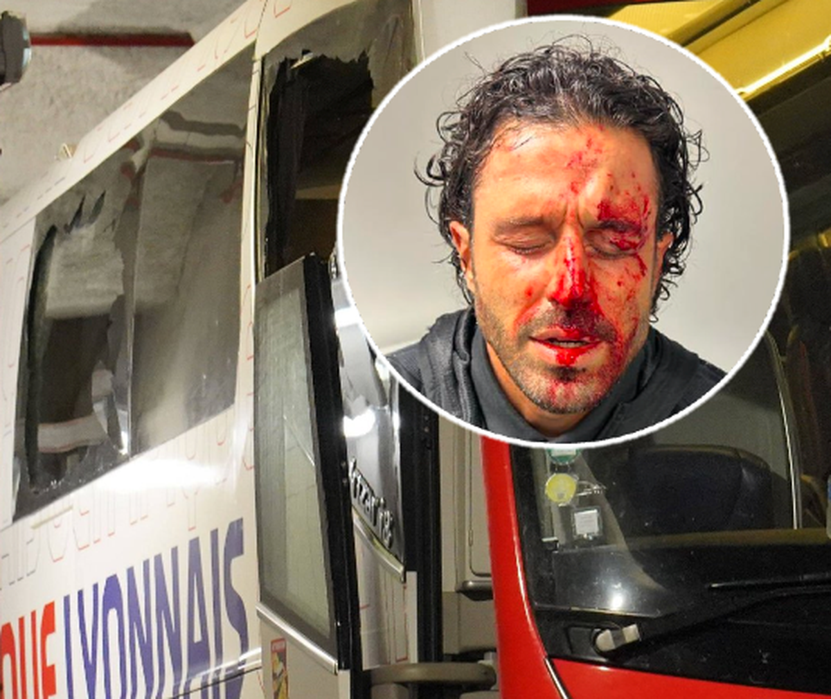 Fabio Grosso a été touché au visage lors du caillassage du car de l'Olympique Lyonnais dimanche à Marseille.