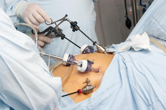 Magenbypass (gastric stapling) Operation